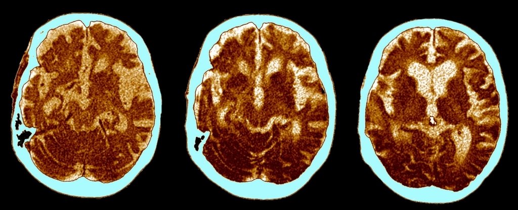 研究表明阿尔茨海默病实际上是 3 种不同的疾病亚型